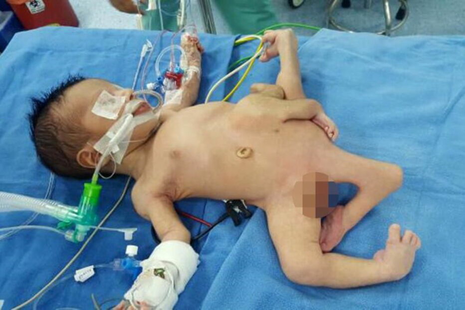 Menino iraquiano que nasceu com oito membros é operado na Índia