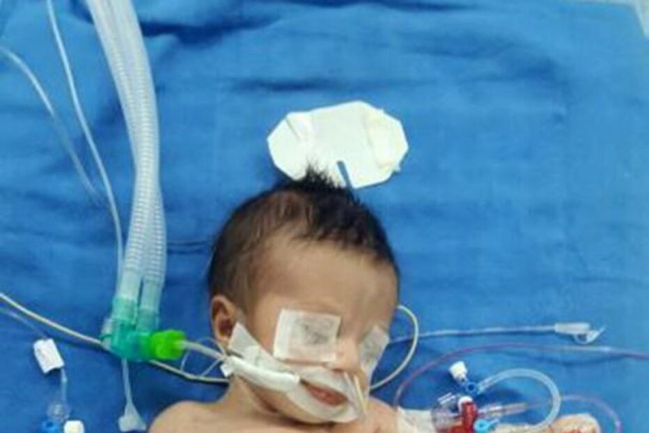 Menino iraquiano que nasceu com oito membros é operado na Índia