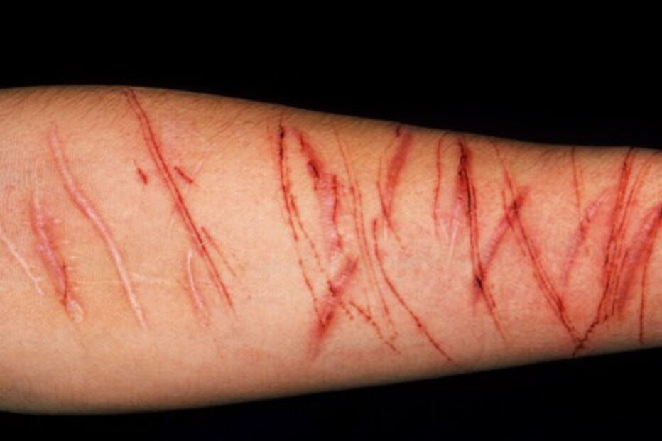 Jovens são incentivados à mutilação e ao suicídio no jogo da 'Baleia Azul'