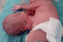 Bebé indiana nasce com duas cabeças