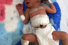 Bebé indiana nasce com duas cabeças