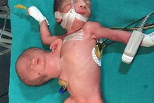 Bebé indiana nasce com duas cabeças