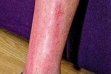 cobra, dentada, mordida, veneno, cobra venenosa, Inglaterra, Tehidy, paralisar, paralisado, John Kiernan