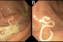 Portugal, Portugal, Anisakis, BMJ, Joana Carmo, Departamento de Gastroenterologia do Hospital Egas Moniz, Lisboa, Japão, Espanha, saúde