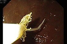 Portugal, Portugal, Anisakis, BMJ, Joana Carmo, Departamento de Gastroenterologia do Hospital Egas Moniz, Lisboa, Japão, Espanha, saúde