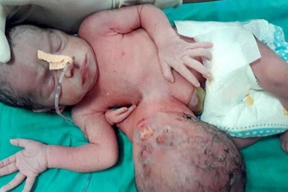 Bebé indiana nasce com duas cabeças