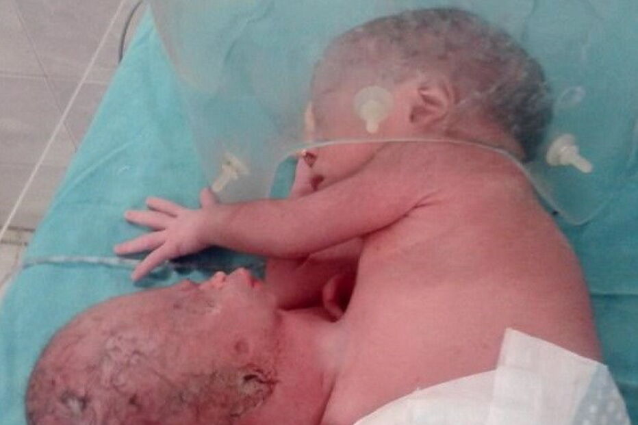 Bebé indiana nasce com duas cabeças