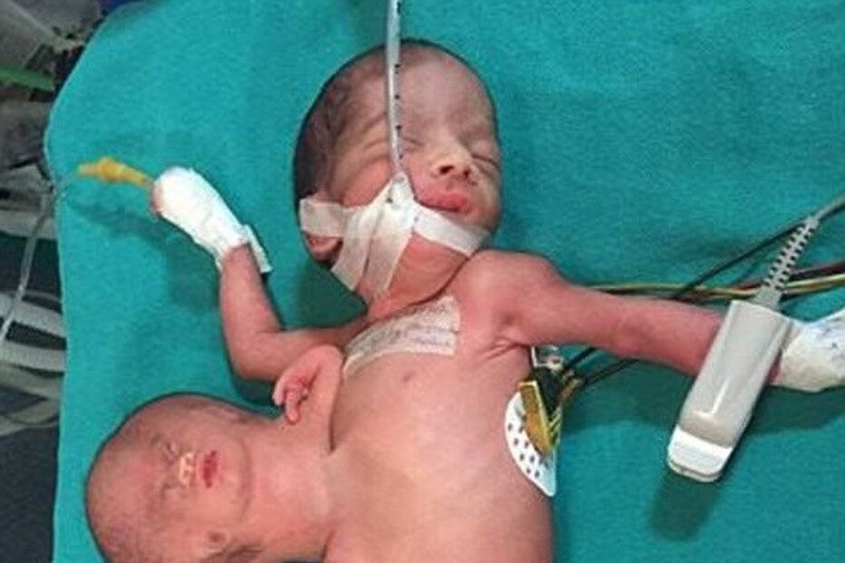 Bebé indiana nasce com duas cabeças