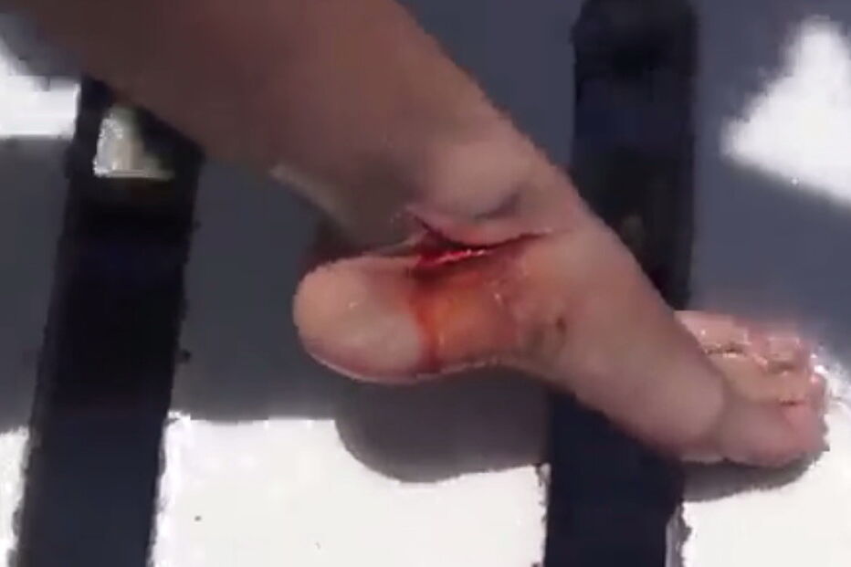 tubarão, Florida, Estados Unidos, Molly Cavalli, dentada, mordida, tornozelo