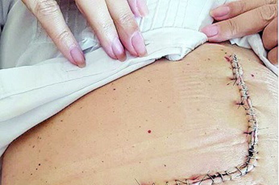 Jô Caneças, cicatriz, cancro, operação, cirurgia, pâncreas, tumor, quimioterapia