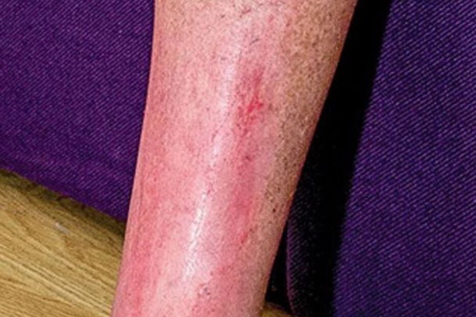 cobra, dentada, mordida, veneno, cobra venenosa, Inglaterra, Tehidy, paralisar, paralisado, John Kiernan