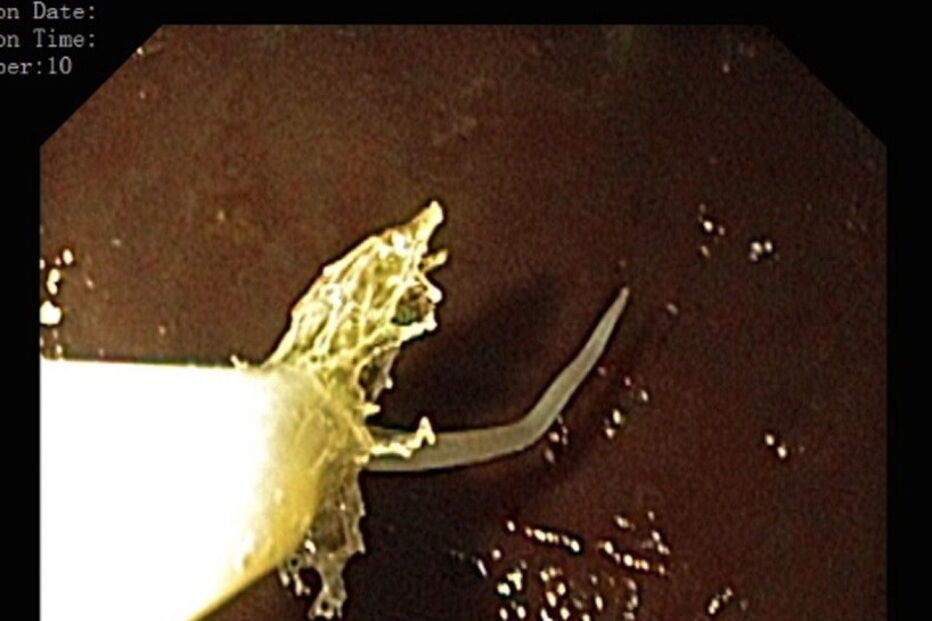 Portugal, Portugal, Anisakis, BMJ, Joana Carmo, Departamento de Gastroenterologia do Hospital Egas Moniz, Lisboa, Japão, Espanha, saúde