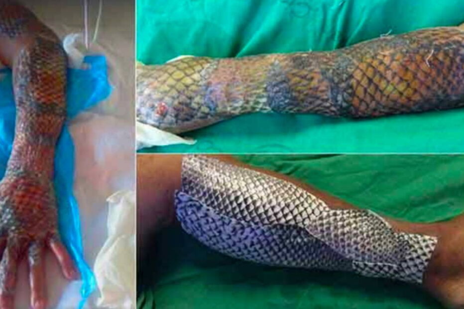 Pele de tilápia, Brasil, queimaduras, tratamento, novo, peixe, barato