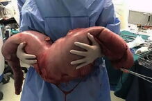 2017-06-10_12_28.03 intestino grosso 3.PNG