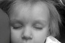 Menina com síndrome de cabelo despenteado 