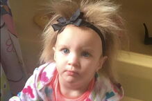 Menina com síndrome de cabelo despenteado 