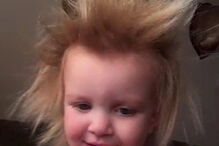 Menina com síndrome de cabelo despenteado 