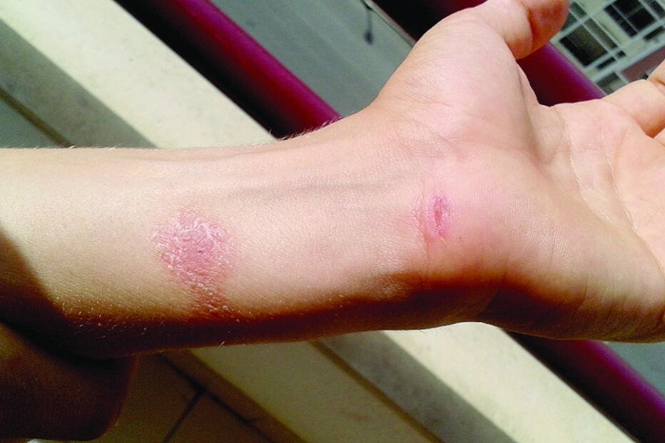 Fotos mostram marcas de golpes com cinto e queimaduras nos braços do aluno de 10 anos dos Pupilos do Exército