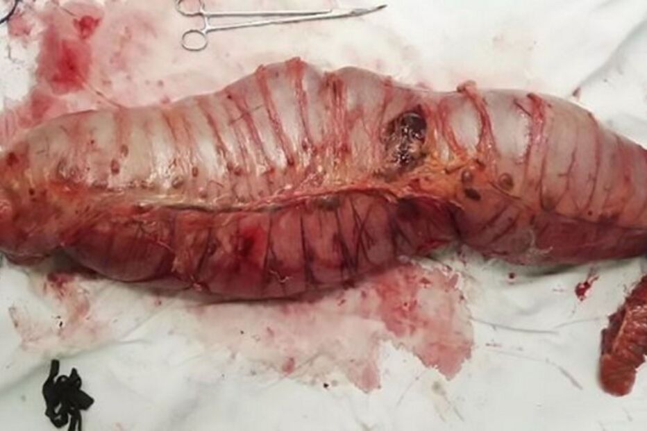 2017-06-10_12_28.02 intestino grosso 1.PNG