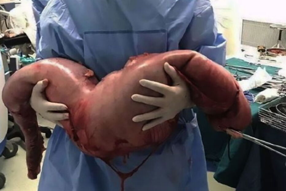 2017-06-10_12_28.03 intestino grosso 3.PNG