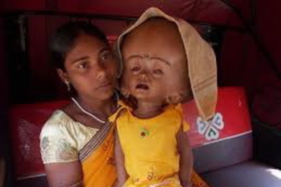 Roona Begum já tinha sido operada várias vezes