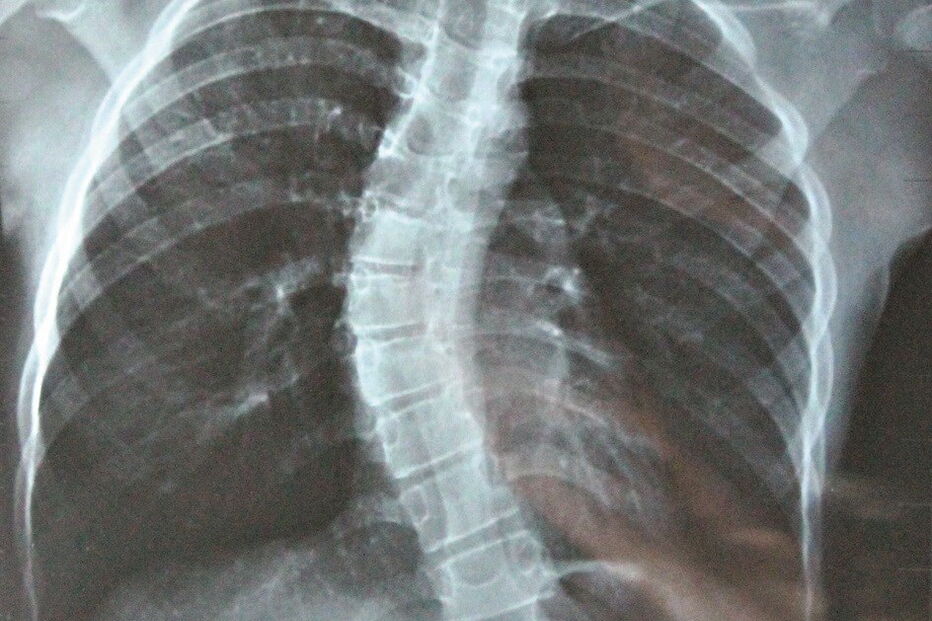 Doença caracterizada por coluna com desvio em forma de 's'