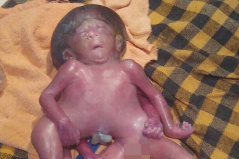 Suresh Saw, Índia, Savita Devi, Doutor Mukesh Kumar, questões sociais, saúde