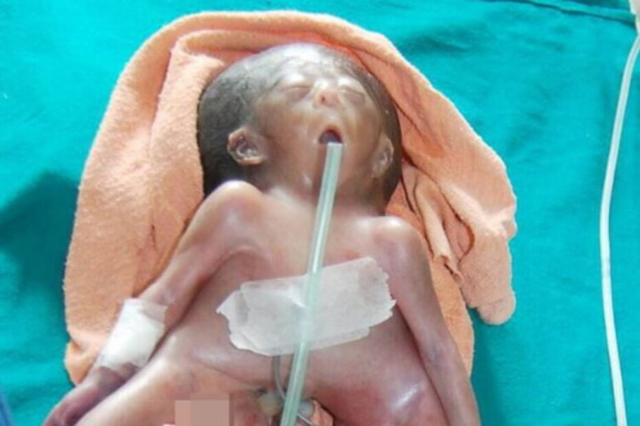 Suresh Saw, Índia, Savita Devi, Doutor Mukesh Kumar, questões sociais, saúde