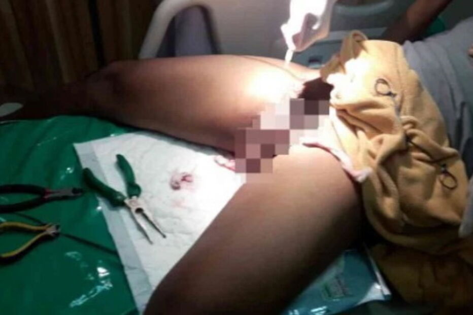 Wirat, Pattaya, Tailândia, Hospital, questões sociais, pénis, anéis, metal, órgão sexual