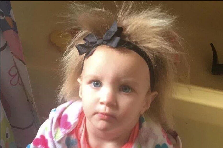 Menina com síndrome de cabelo despenteado 