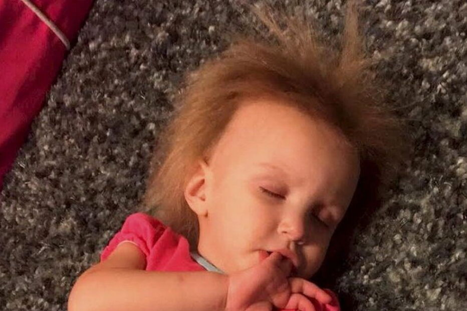 Menina com síndrome de cabelo despenteado 