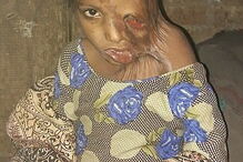 Julie, de 7 anos, foi agora ajudada pela Fundação Chhanv