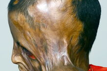 Julie, de 7 anos, foi agora ajudada pela Fundação Chhanv