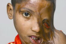 Julie, de 7 anos, foi agora ajudada pela Fundação Chhanv