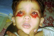 Menina de três anos chora lágrimas de sangue