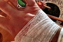 Fotodermatite causada por sumo de limão