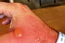 Fotodermatite causada por sumo de limão