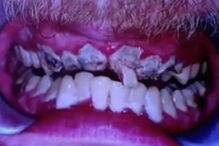 Homem mostra os dentes depois de 20 anos sem os escovar