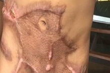 Criança de cinco anos sofreu queimaduras no abdomén, genitais e pernas