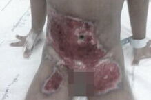 Criança de cinco anos sofreu queimaduras no abdomén, genitais e pernas