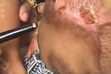 Criança de cinco anos sofreu queimaduras no abdomén, genitais e pernas