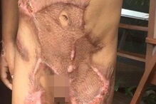 Criança de cinco anos sofreu queimaduras no abdomén, genitais e pernas