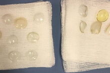 No total, os médicos retiraram 27 lentes de contacto de um olho da paciente