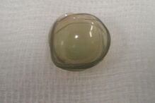 No total, os médicos retiraram 27 lentes de contacto de um olho da paciente