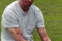 Vítima de ácido, Inglaterra, Daniel Rotariu