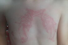 Menino de sete anos sofre queimaduras após fazer tatuagem de henna