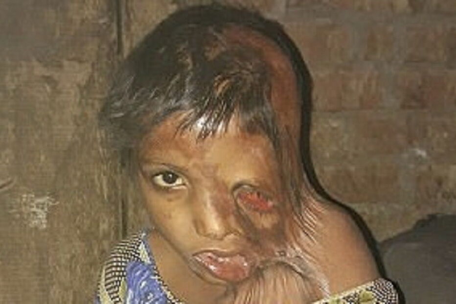 Julie, de 7 anos, foi agora ajudada pela Fundação Chhanv