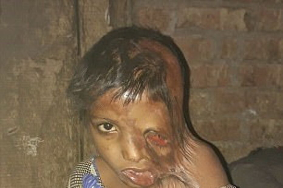 Julie, de 7 anos, foi agora ajudada pela Fundação Chhanv