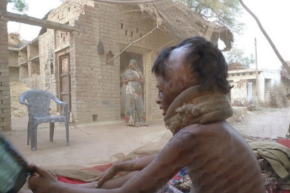 Julie, de 7 anos, foi agora ajudada pela Fundação Chhanv