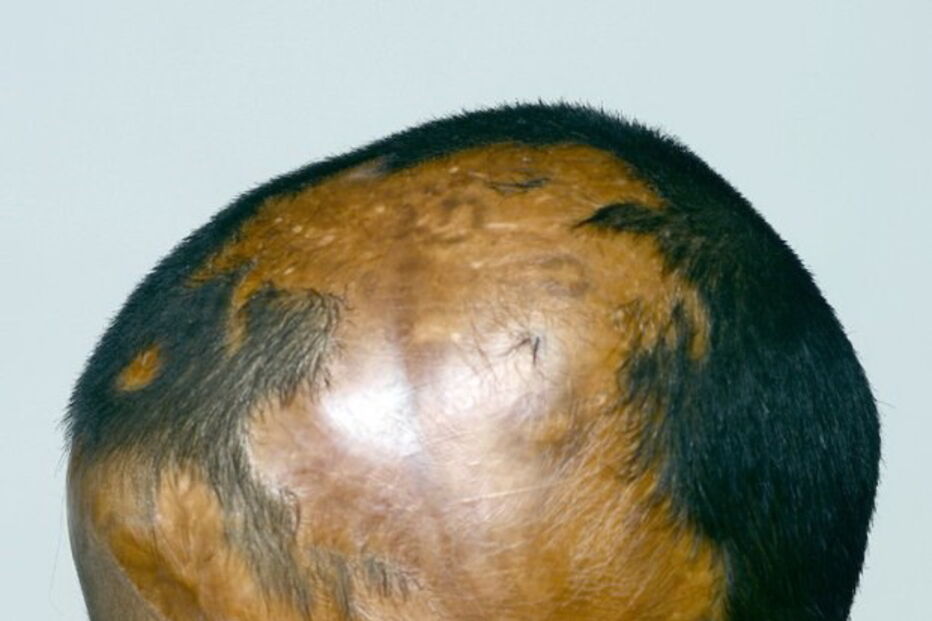 Julie, de 7 anos, foi agora ajudada pela Fundação Chhanv